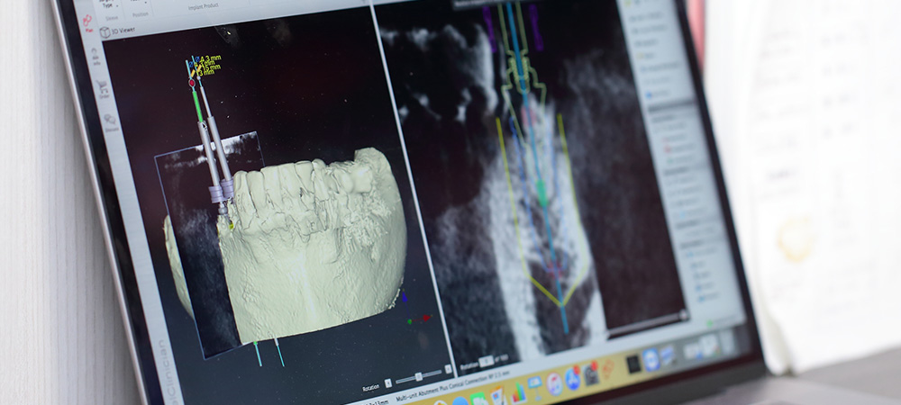 正確性の高いインプラント治療はガイデッドサージェリーに限ります