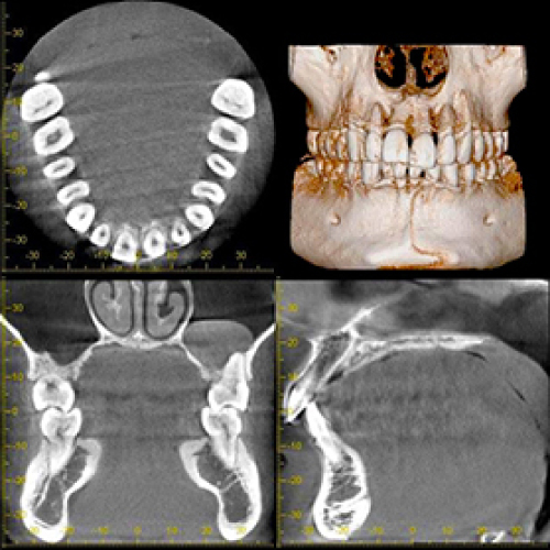 歯科用CTによる精密診断